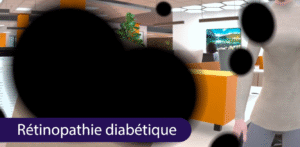 Personne ayant une rétinopathie diabétique qu'on retrouve dans notre formation handicap en entreprise